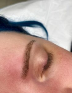 Immediately after eyebrow removaln